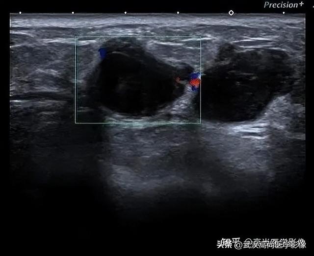 乳腺结节BI-RADS分级标准，看这篇就够了！「武汉高尚医学影像」