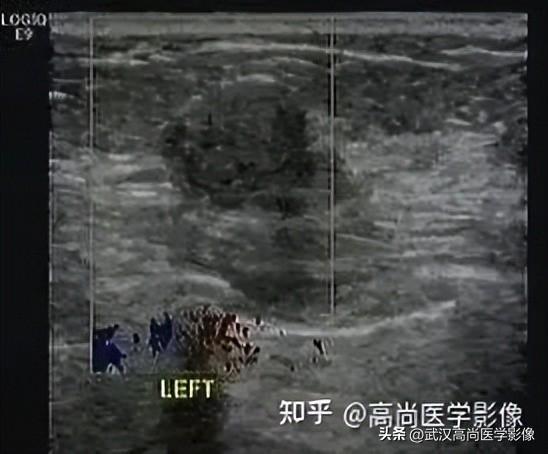 乳腺结节BI-RADS分级标准，看这篇就够了！「武汉高尚医学影像」