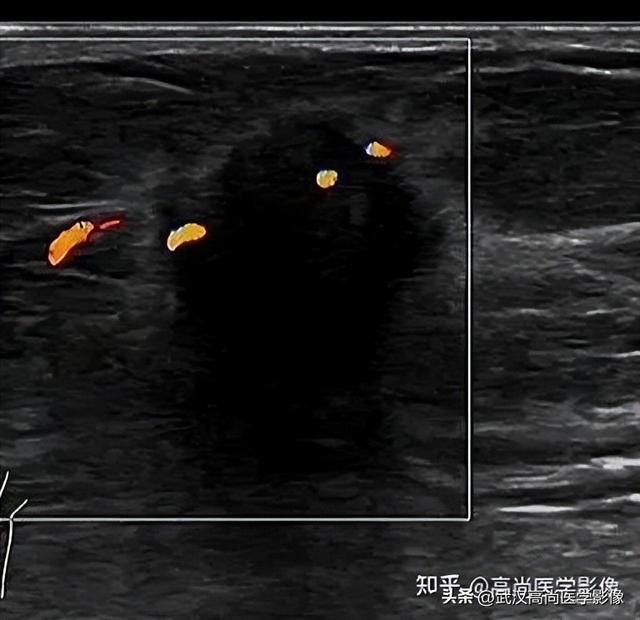 乳腺结节BI-RADS分级标准，看这篇就够了！「武汉高尚医学影像」