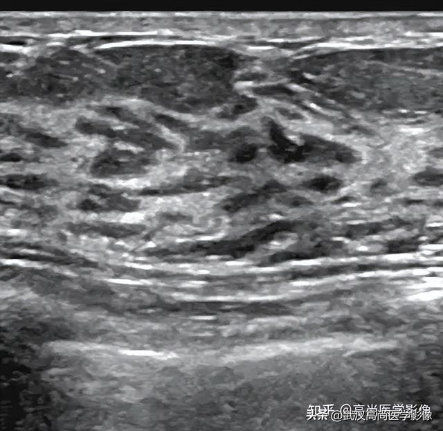 乳腺结节BI-RADS分级标准，看这篇就够了！「武汉高尚医学影像」